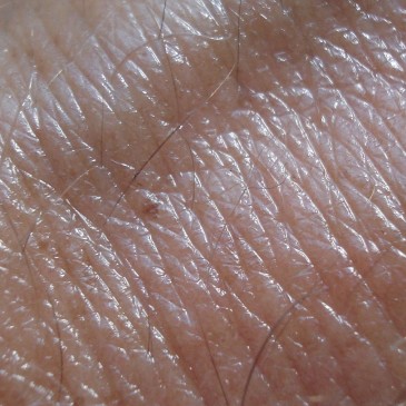 Léčbě chronické dermatitidy významně napomáhá detoxikace organismu a úprava jídelníčku
