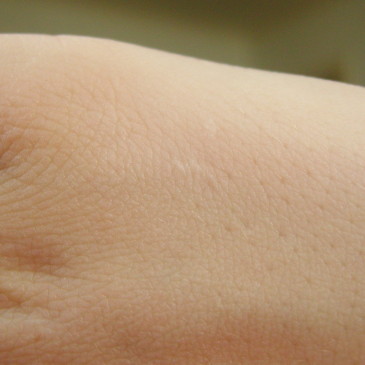 Podzim přináší výrazné zhoršení kožních nemocí. Jak si ulevit od potíží?